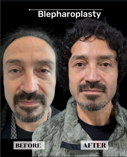 Eyelid surgery before and after, patient 1 - Allure RT MX