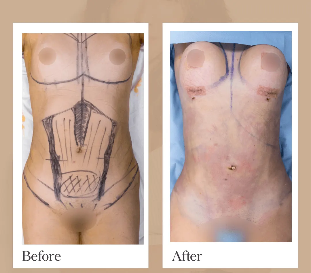 Mommy Makeover operative result, patient 1 - Allure RT MX