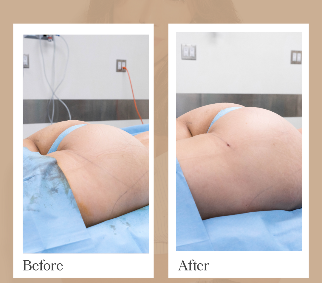 Body contouring operative result, patient 12 - Allure RT MX