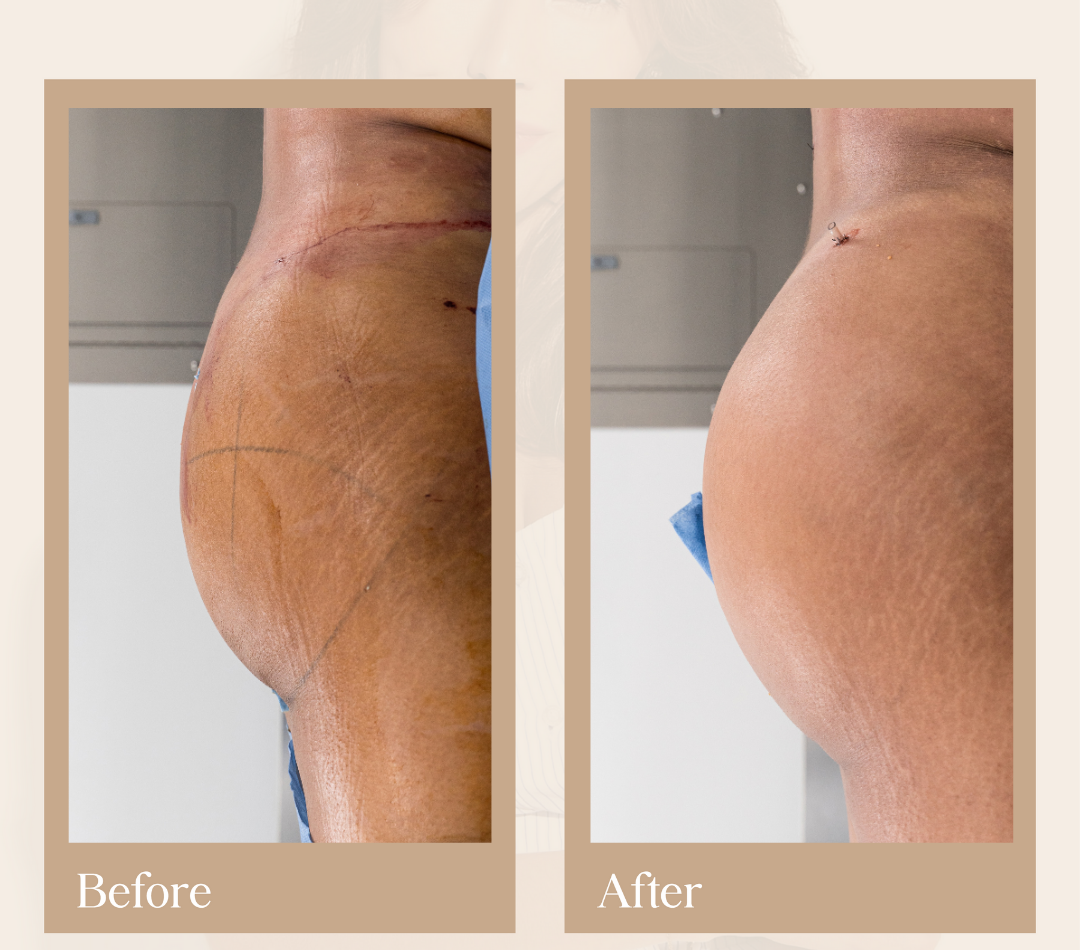Tummy tuck operative result, patient 13 - Allure RT MX