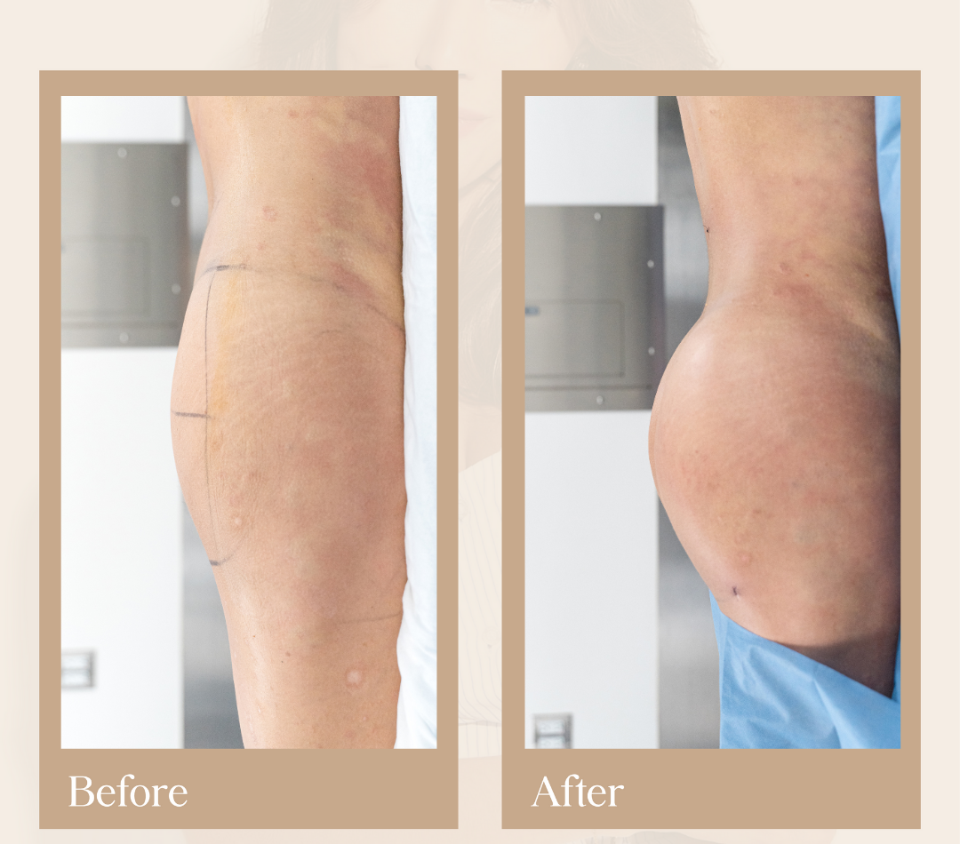 Body contouring operative result, patient 14 - Allure RT MX