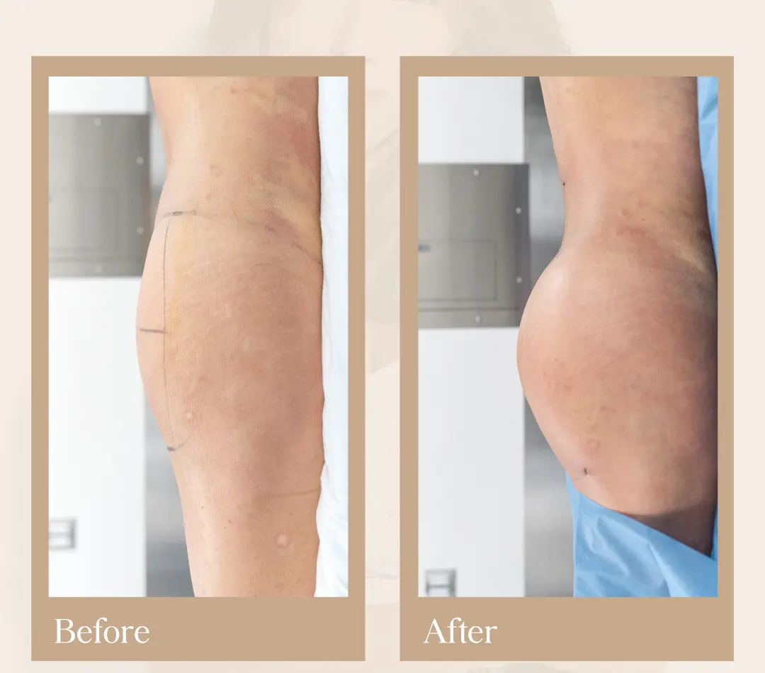 Body contouring operative result, patient 14 - Allure RT MX