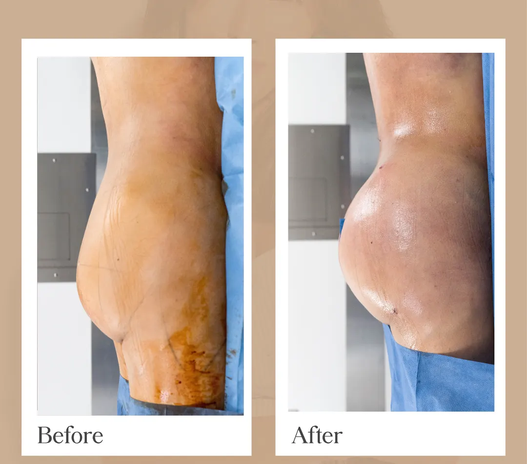 Facelift operative result, patient 15 - Allure RT MX