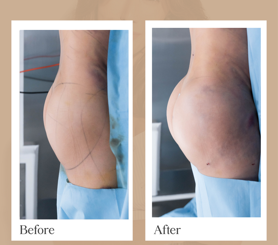Body contouring operative result, patient 16 - Allure RT MX