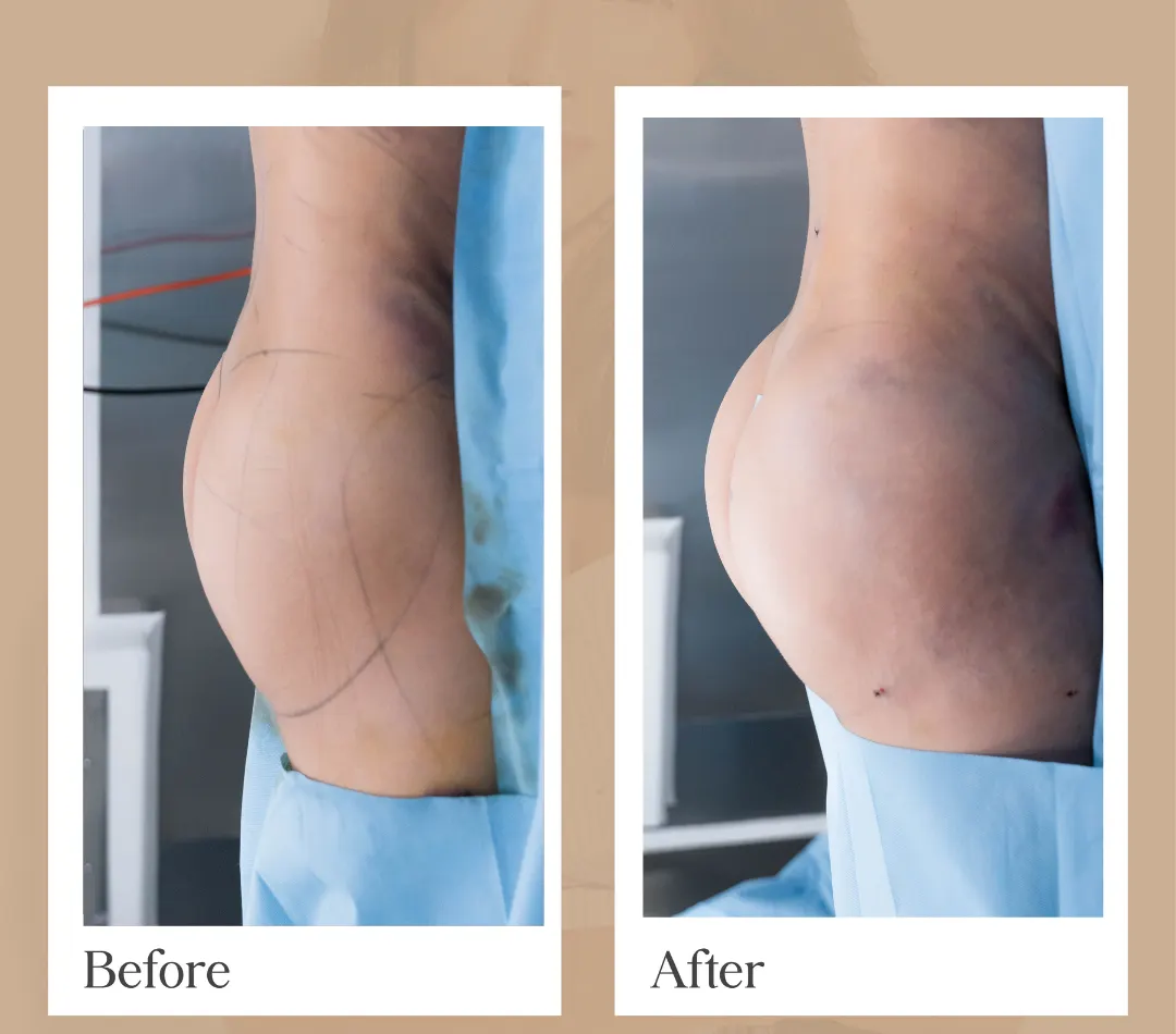 Body contouring operative result, patient 16 - Allure RT MX