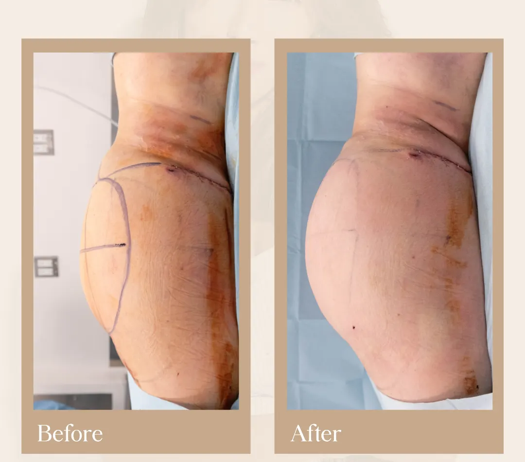 Body contouring operative result, patient 17 - Allure RT MX