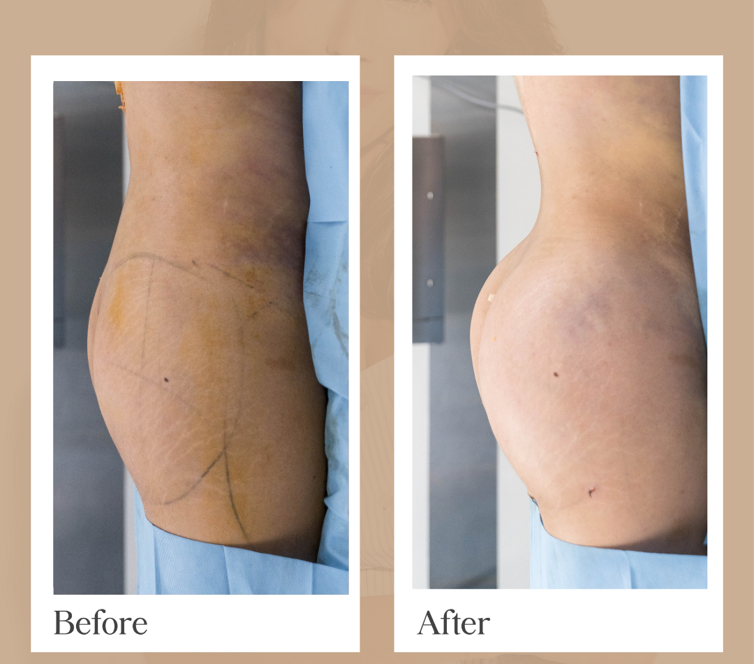 Mommy Makeover operative result, patient 18 - Allure RT MX