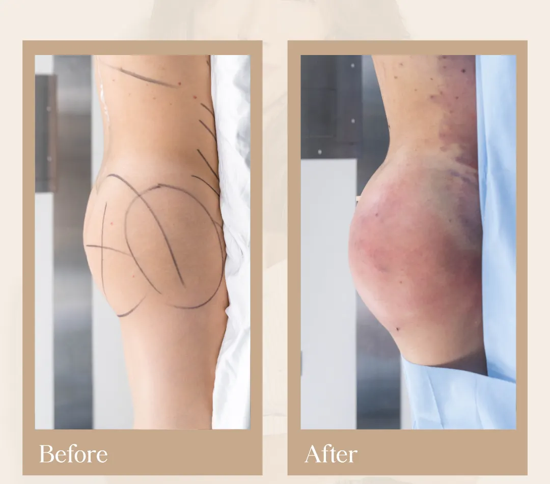 Body contouring operative result, patient 19 - Allure RT MX
