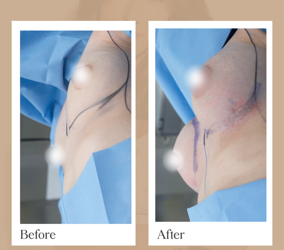 Body contouring operative result, patient 20 - Allure RT MX