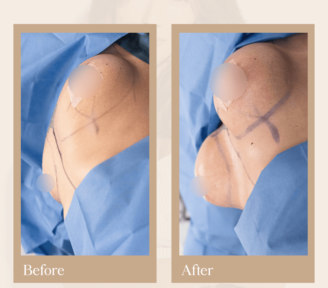 Body contouring operative result, patient 21 - Allure RT MX