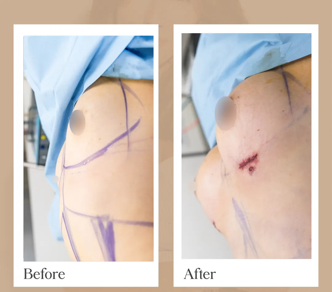 Body contouring operative result, patient 22 - Allure RT MX
