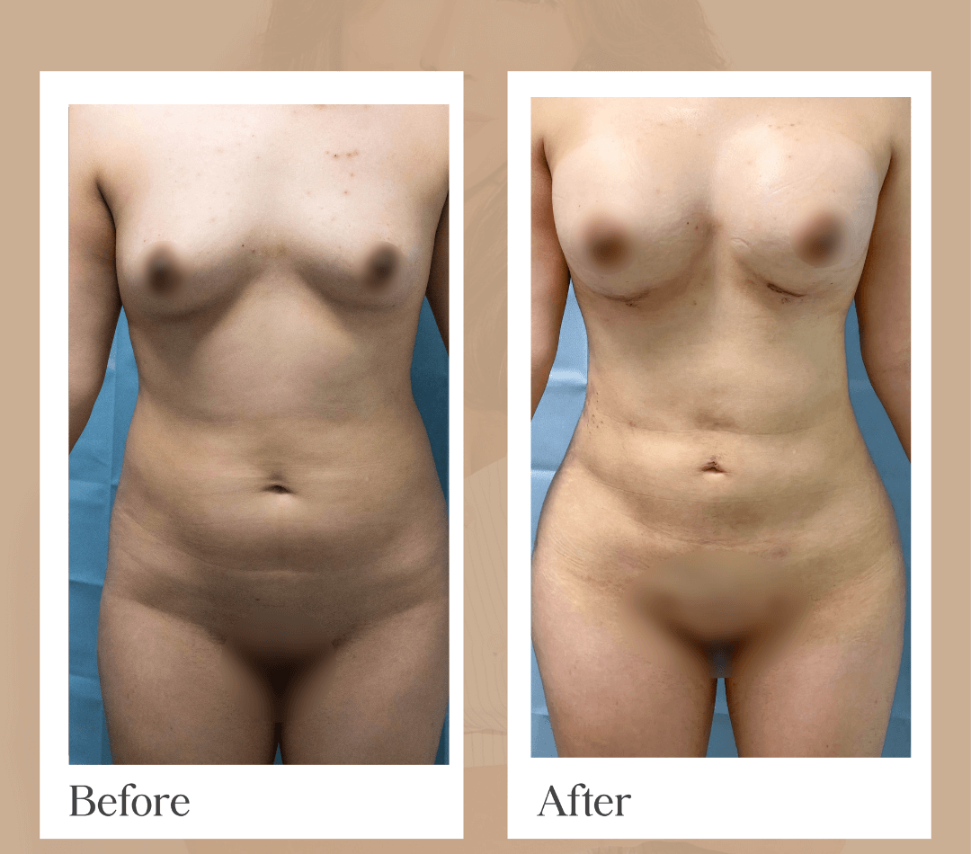 Liposuction operative result, patient 3 - Allure RT MX