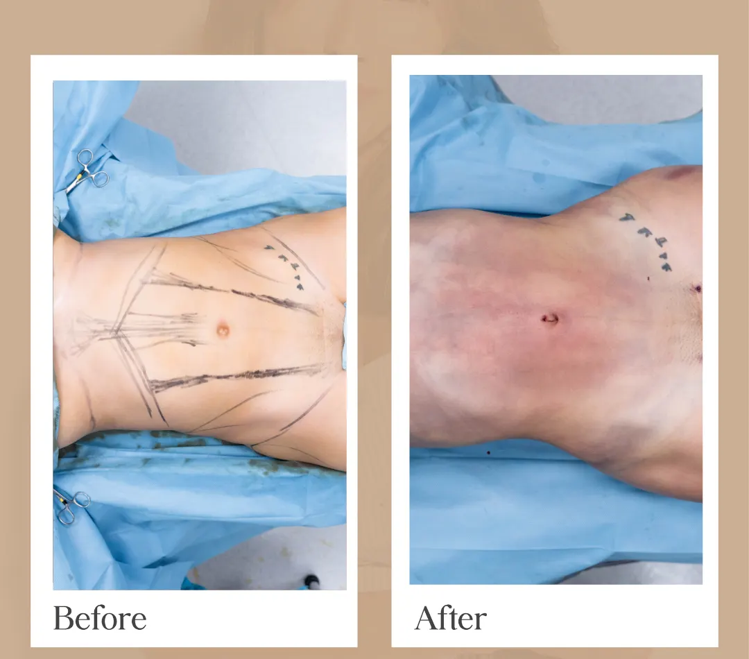 Breast augmentation operative result, patient 7 - Allure RT MX