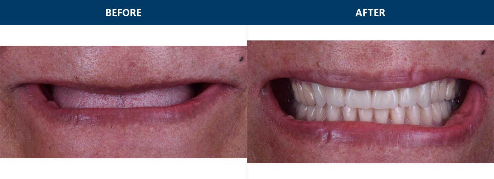Before and after of a full-mouth restoration -- edentulous arch on the left, finished dentures on the right.