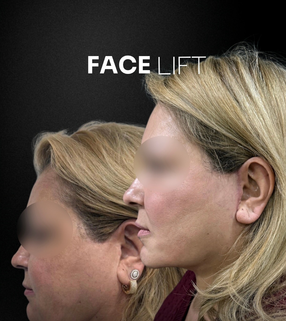 Facelift before and after, patient 1 - Allure RT MX