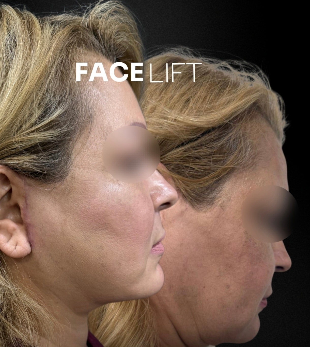 Facelift before and after, patient 2 - Allure RT MX