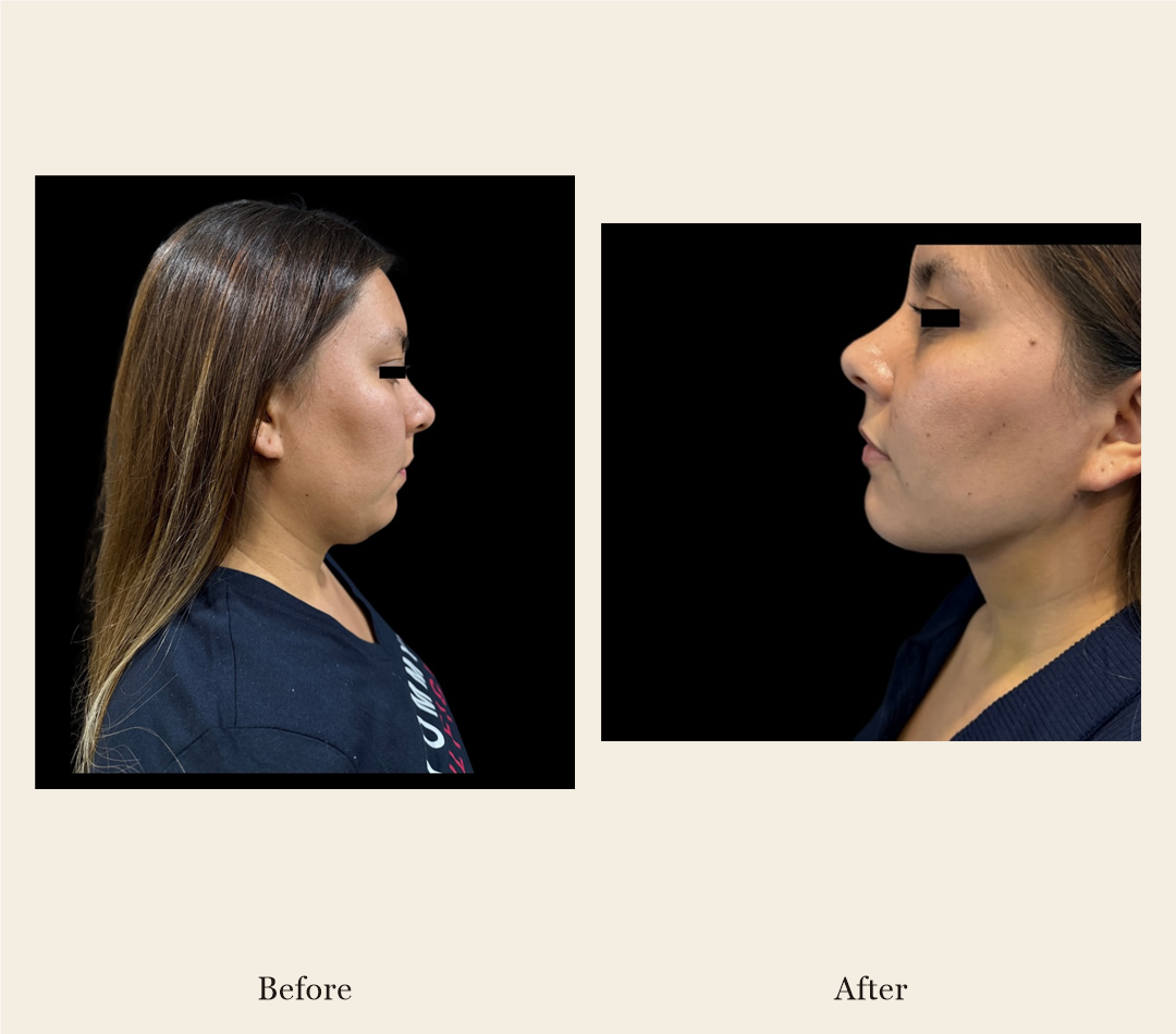 Facelift before and after, patient 3 - Allure RT MX