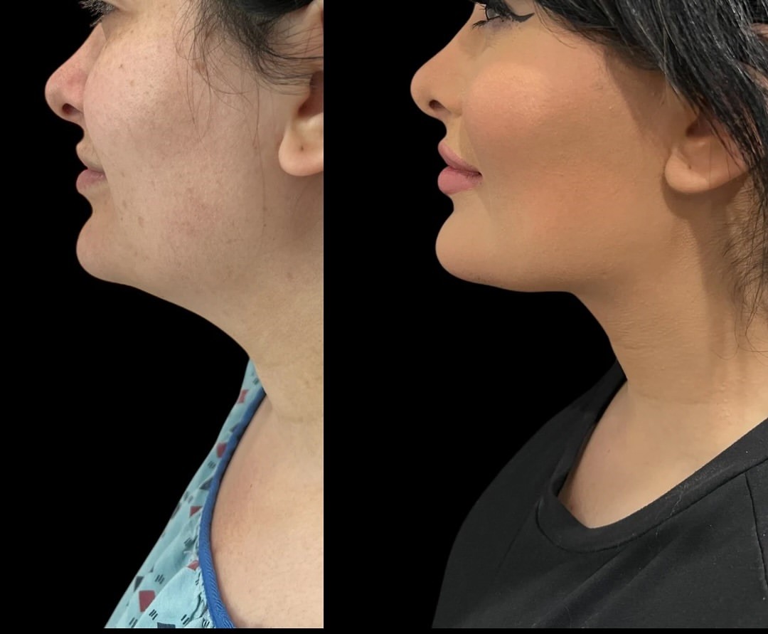 Submental liposuction before and after, patient 1 - Allure RT MX