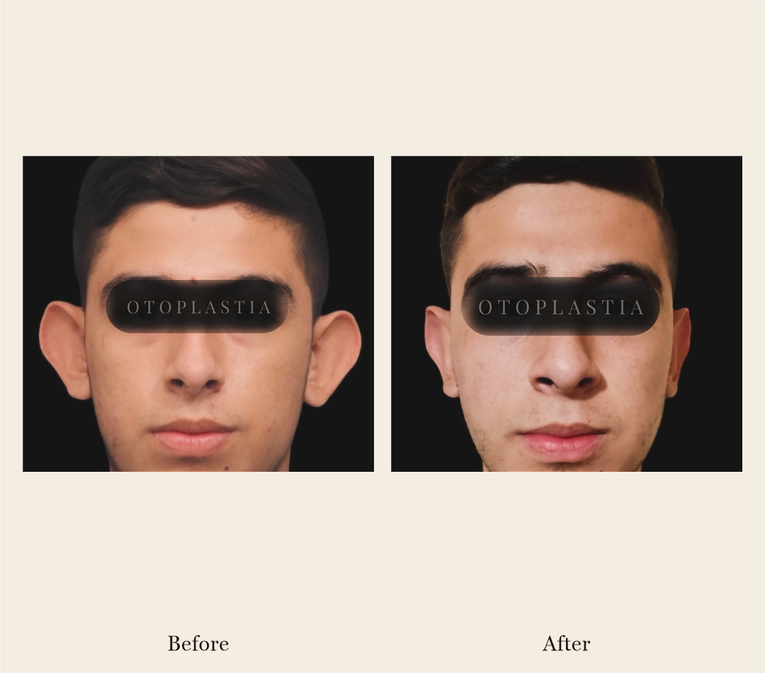 Otoplasty before and after, patient 1 - Allure RT MX