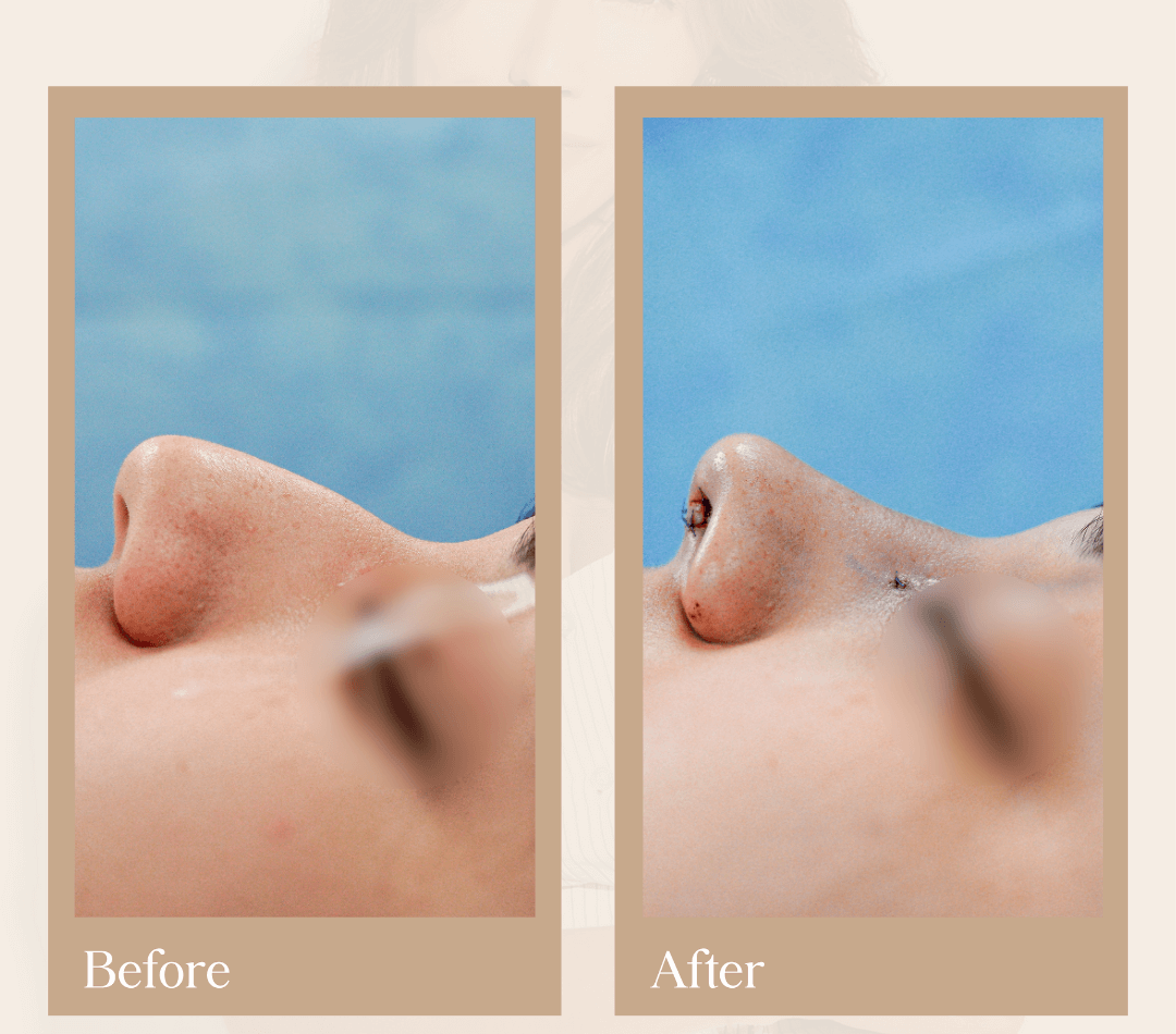 Rhinoplasty operative result, patient 2 - Allure RT MX