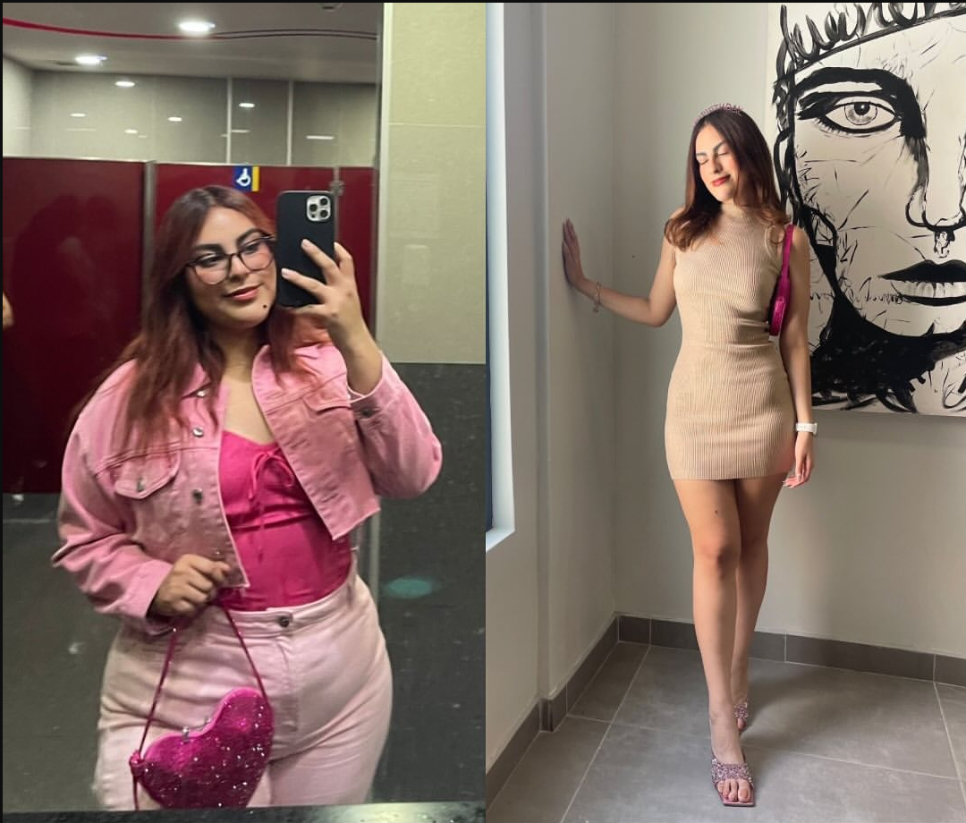 Gastric sleeve before and after, patient 1 - Allure RT MX