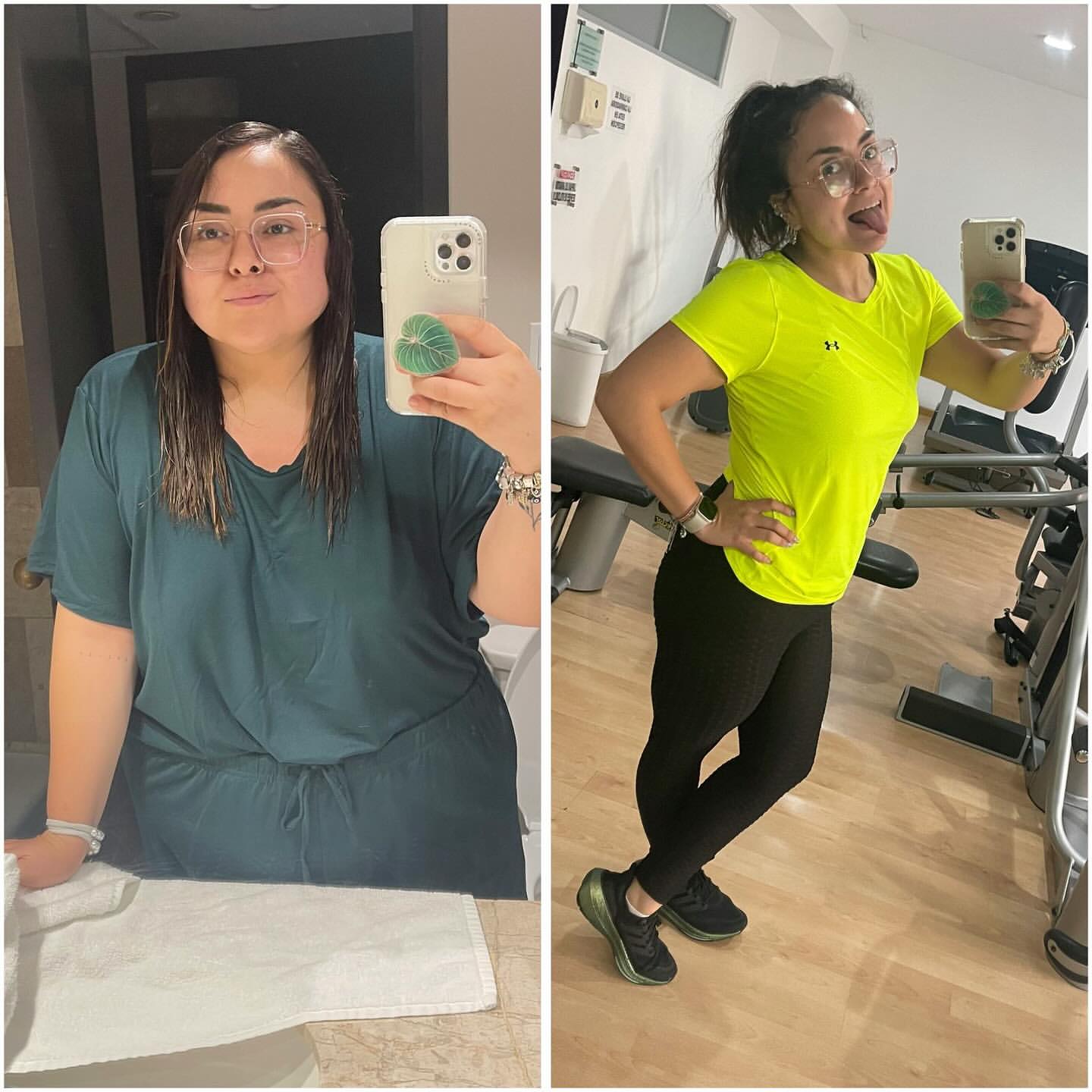 Gastric sleeve before and after, patient 2 - Allure RT MX