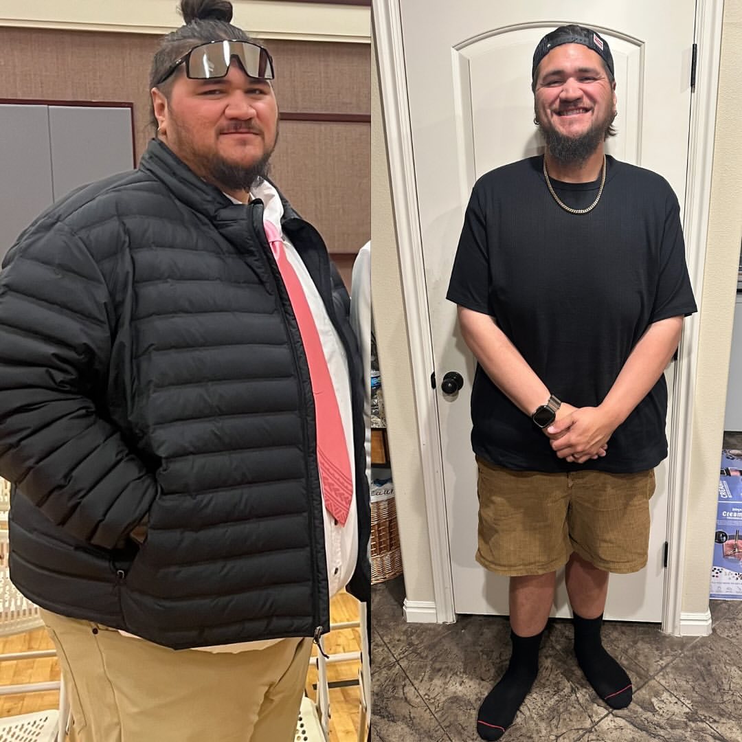 Gastric sleeve before and after, patient 7 - Allure RT MX